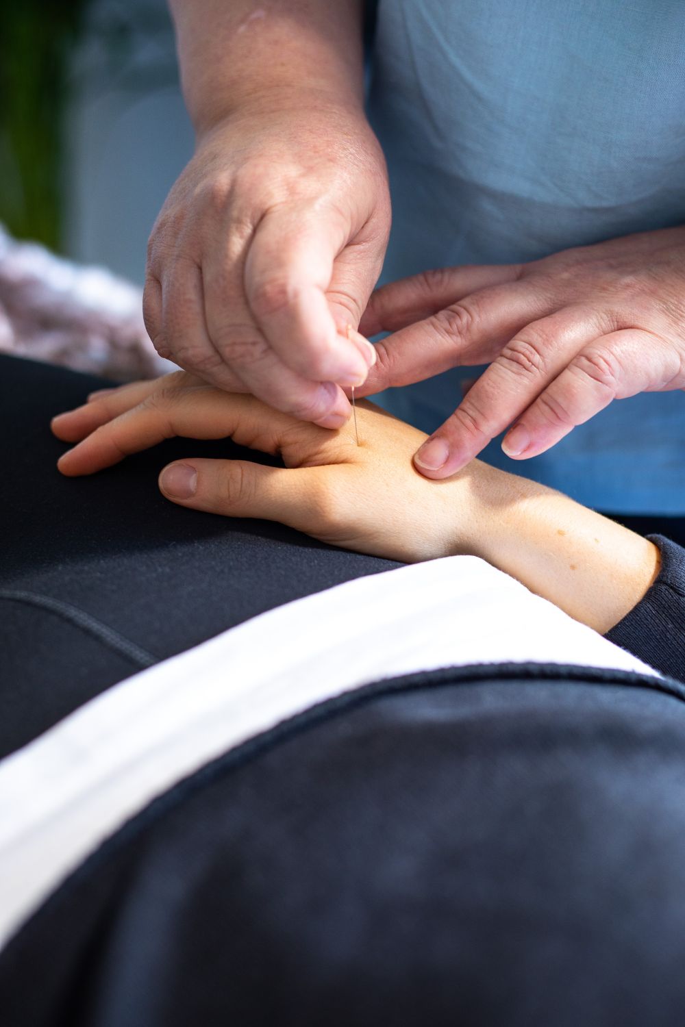 Close-up of acupuncture needles being placed on a hand. Dublin brand photography by Chiara Gianelli.